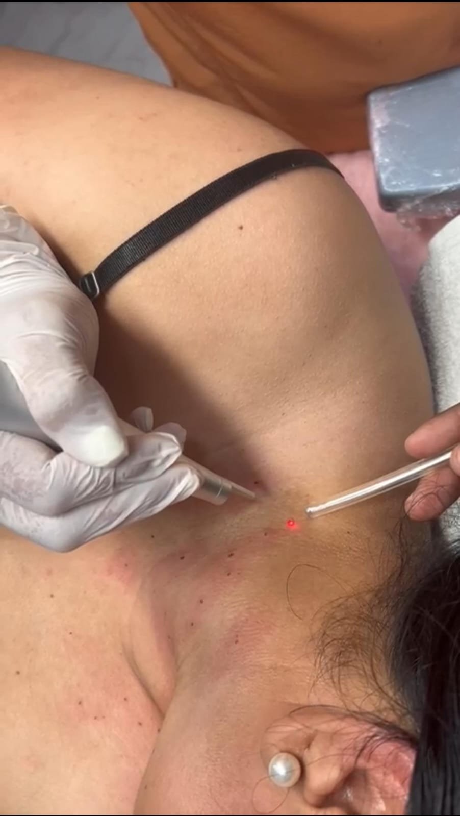 Cauterización laser