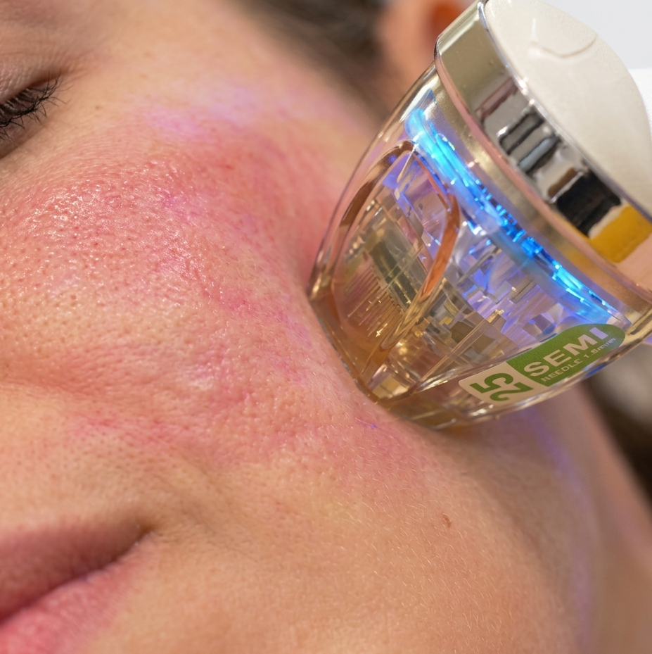 Radiofrecuencia Fraccionada Facial